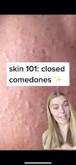 Comedones are pores or hair follicles that have gotten blocked with bacteria, oil, and dead skin cells to form a bump on your skin. If You Re Dealing With Closed Comedones The Video Is For You Closedcomodones Skincare Acne Acnetreatment