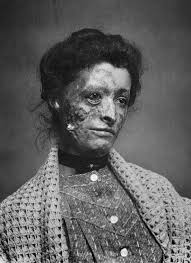 And, where did you get it anyway? Effects Of Syphilis Before Salvarsan And Penicillin Became Available 1880 1910 Morbidhistory