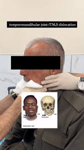 Image result for Jaw Dislocation