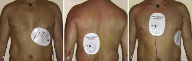 Image result for Transcutaneous Pacing