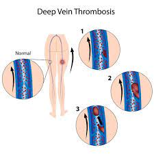 Treating Deep Vein Thrombosis With Angioplasty And Stenting