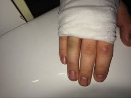 Der unbestimmte artikel (ein, eine, ein) bildet keinen plural. Ich Habe Eine Schnittverletzung Die Genaht Wurde Und Mein Finger Schwillt Blau An Was Kann Das Sein Verletzung