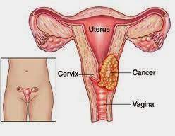 Bu kanserlerin nedeni çok büyük bir olasılıkla human papilloma virusu'nun (hpv) neden. Klinik Dr Zaharuddin Kl Gynaecologist Kanser Pangkal Rahim Serviks Cancer Of Cervix