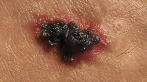The domain name was registered at least 60 days ago with. Skin Cancer Half Of People Surviving Advanced Melanoma Bbc News
