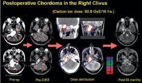 Maybe you would like to learn more about one of these? A Case Presentation Of A 25 Year Old Woman With Skull Base Chordoma Download Scientific Diagram