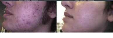 Η εγκυμοσύνη αποτελεί παράγοντα κινδύνου για την ανάπτυξη και την επιδείνωση των αιμορροΐδων. Apotrixwsh Me Laser