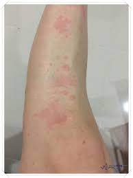 Simon, spkk dikenal akan kepiawaiannya dalam mengobati bopeng dengan penggunaan ematrix dan juga penggunaan laser diode. Klinik Specialist Wong Treating Skin Allergies I M Saimatkong