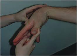 Compare the pain on the suspected side to the asymptomatic side. De Quervain S Tenosynovitis Effective Diagnosis And Evidence Based Treatment Intechopen