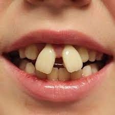 Luckily there are other ways to straighten your teeth without getting braces fitted. Patient Warning Do Not Attempt Diy Teeth Straightening California Association Of Orthodontists