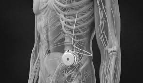 Image result for Intrathecal Pump