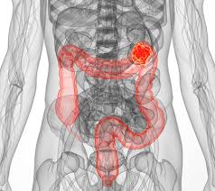 Bowel cancer australia is committed to championing what matters most to people affected by bowel cancer. Bowel Cancer Australia Awareness Support Research