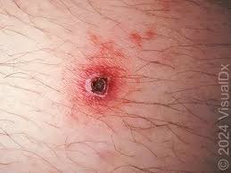 Image result for Rickettsialpox