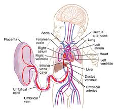 Image result for Delayed Transition from Fetal Circulation