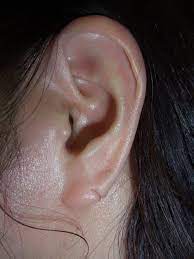 ピアスによる耳切れ耳垂裂がこんなにきれいになります！（画像あり） | 神楽坂肌と爪のクリニック