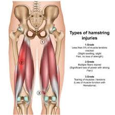 Mar 15, 2021 · when the hamstring muscle group contracts, it can cause a posterior pelvic tilt, or the tipping of the tailbone down towards the back of the thigh. Hamstring Strains 5 Important Exercises For Recovery Bsr Physical Therapy