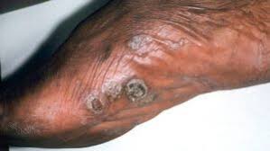 Image result for pompholyx soles of feet