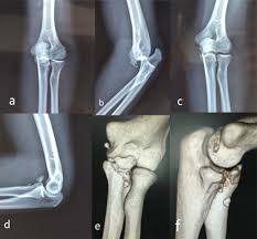 Image result for Coronoid Process Fracture