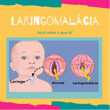 1 division of pediatric otolaryngology information on laryngomalacia what is laryngomalacia? Laringomalacia Voce Sabe O Que E Abope Academia Brasileira De Otorrino Pediatrica