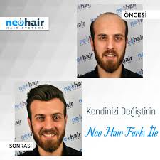 Neo Hair Adli Kullanicinin Erkek Protez Sac Panosundaki Pin Sac