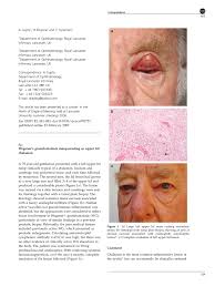 PDF) Wegener's granulomatosis masquerading as upper lid chalazion