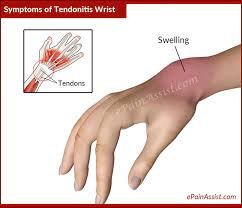 Signs And Symptoms Of Tendonitis Wrist Or Wrist Tendinitis Wrist Tendonitis Tendinitis Tendonitis Treatment
