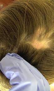 However, it can take months. Management Of Lupus Erythematosus Alopecia Ccid