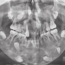 Most people with cherubism have few, if any, signs and symptoms affecting other parts of the body. 11 Year Old Male With Cherubism Showing The Typical Disorganization Of Download Scientific Diagram