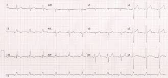 It is located in the wall of the right atrium. Coronary Sinus Rhythm