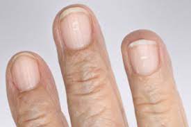 In many cases, ckd is only found when a routine blood or urine test you have for another problem shows that. 6 Things Your Nails Say About Your Health Health Essentials From Cleveland Clinic