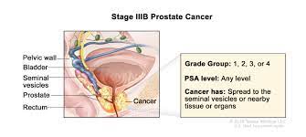 Urologic Oncology Conditions: Prostate Cancer | Department of Urology