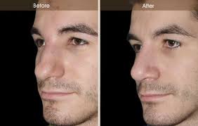 This Is A 21 Year Old Gentleman Who Suffered A Severe Nasal Injury Resulting In A Significant Nasal Fracture And Fractured Nasal Septum This Resulted In A Very