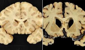 | brain injury research institute. Arizona Researchers May Have First Cte Test For Living People