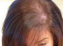 Previous page many women also note a thinning of pubic and underarm hair after menopause. Postmenopausal Hair Loss Treatment Solution Menopause Briefs