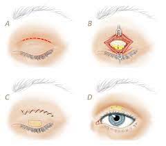 Bell's palsy can interrupt the eyelid's natural blinking ability, leaving the eye exposed to irritation and drying. How Does Facial Paralysis Bell S Palsy Affect The Eyes