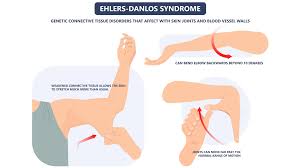 Image result for Hypermobility Signs