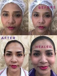 Whatever the reason, we are here to help you achieve your cosmetic tattooing goals. Eyebrow Tattoo Patong Permanent Makeup Phuket Eyelash Extension Patong à¸ª à¸à¸„ à¸§à¸  à¹€à¸ à¸• Cosmetic Tattoo Aufnahme Von Browtiful Phuket By Jk Tripadvisor