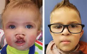 Image result for Cleft Lip