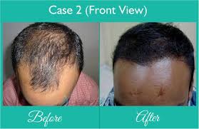 Best Hair Transplant Done At Dezire Clinic Pune Visit Our Website To Know Details Of Best Hair Transplan Best Hair Transplant Cosmetic Surgery Plastic Surgery