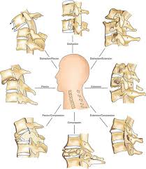Image result for Subaxial Injury Classification Scale