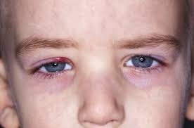 Sti på øyelokket går ofte langt raskere over dersom den behandles kirurgisk. Sti Hos Barn Hvordan Behandle Dem Du Er Mamma