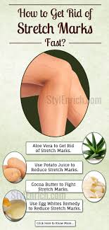If You Are Looking Forward To Get Rid Of Stretch Marks Diyskincare Home Remedies Are Your S Stretch Marks Stretch Mark Removal Remedies Stretch Mark Remedies