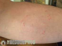 Image result for bedbugs bites