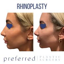 Before & After: Rhinoplasty— This woman came into Preferred Plastic Surgery  for a Rhinoplasty because she did not like the shape of her nose. After her  consultation, Dr. Malek and this patient
