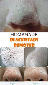4 Simple Ways To Use Tea Tree Oil To Remove Blackheads My Health Get Rid Of Blackheads Blackheads Natural Treatments