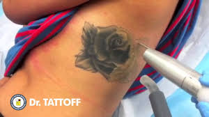 Duplechain for laser tattoo removal from baton rouge, lafayette, and alexandria, la. Tattoo Removal Houston Texas Laser Tattoo Removal Procedure Of Rose Tattoo Youtube