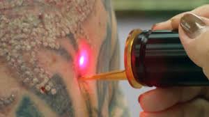 Some people have higher pain tolerances to begin with so what might 'hurt' some tattoo removal is a long process, it requires many laser treatments to remove even the smallest tattoo. Tattoo Removal Costs How Much Is Laser Tattoo Removal Authoritytattoo