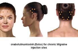 How long for botox to work for migraines. Botox For Chronic Migraine Knowledge Of Anatomy Is Critical