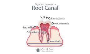Failed Root Canal Symptoms Omega Dental Houston Tx