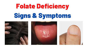 Image result for Folate Deficiency