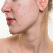 The sooner you can act on it, the better. Home Remedies To Get Rid Of Red Spots On The Skin Fashion Goalz